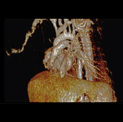 cardiovascular image Appendix video